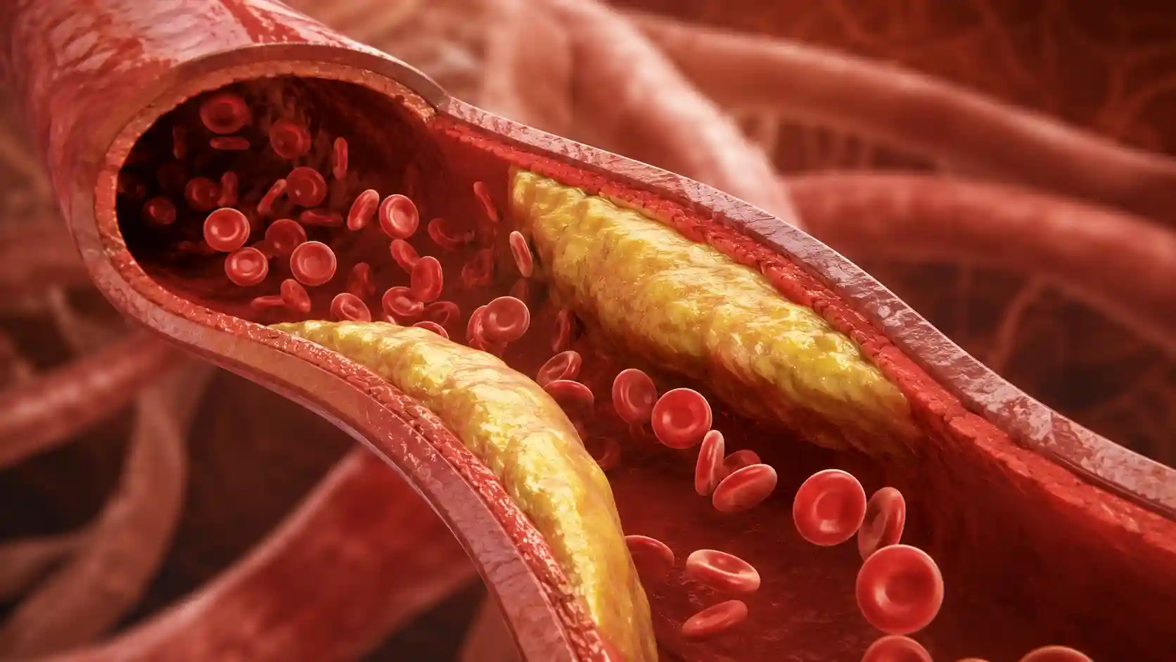 Hyperlipidemia showing cholesterol plaque narrowing an artery with red blood cells flowing through